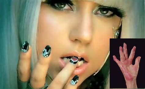 Celebridades.: Lupus em Lady Gaga.