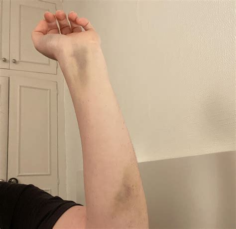 What does this wrist bruise mean 16 days after an elbow fracture? : r