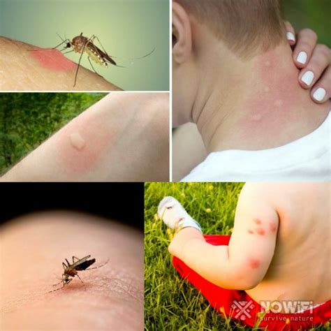 Фото укусов насекомых с описанием: что нужно знать