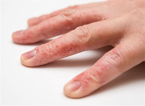 eczema  left hand  amy beasley blog