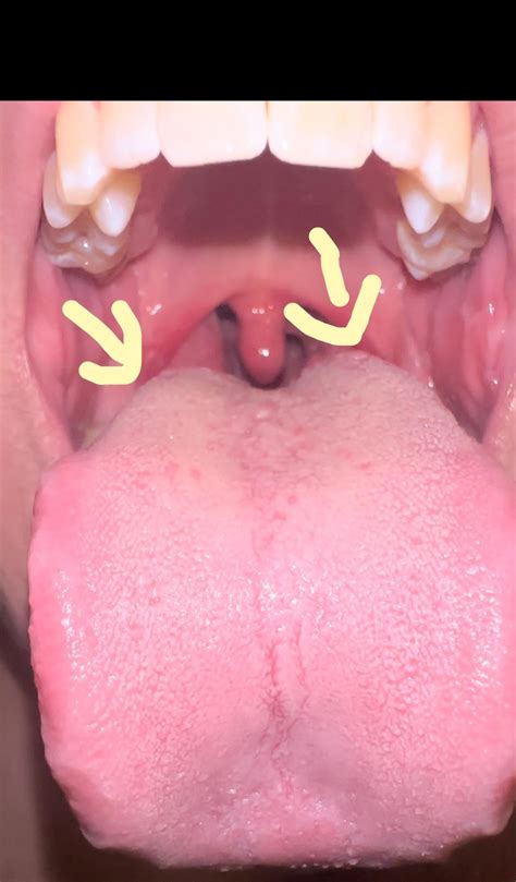 Bumps on tongue? : r/medical
