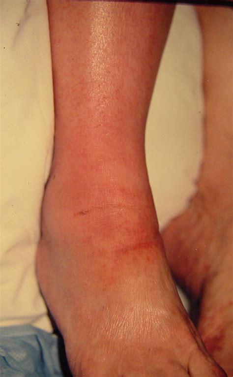 Lymph Node 0556 Leg Swelling And Redness Lymphoma 1 | Surgery Photos