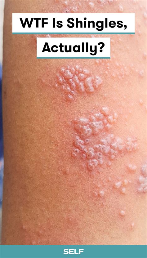 Stages of shingles – Artofit