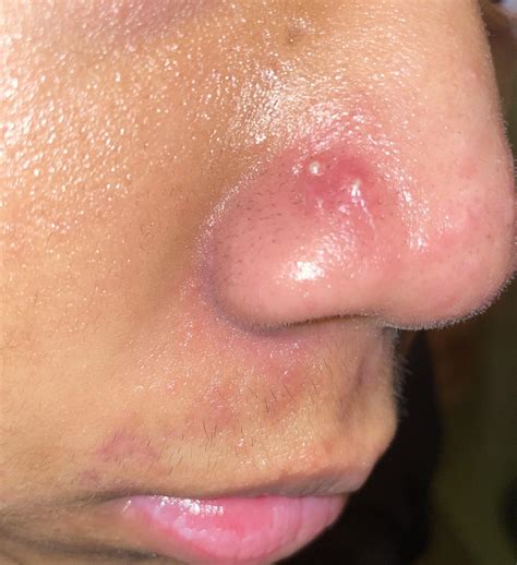 acne vulgaris  acne rosacea     treat iton