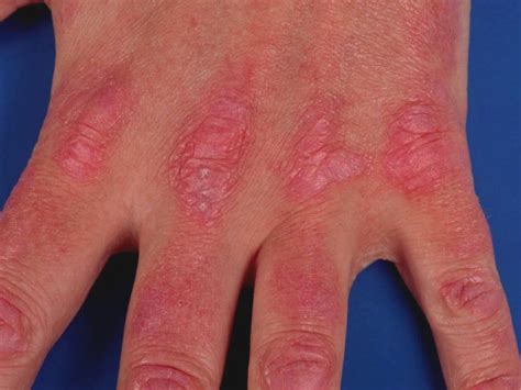 Dermatomyositis Skin Rash