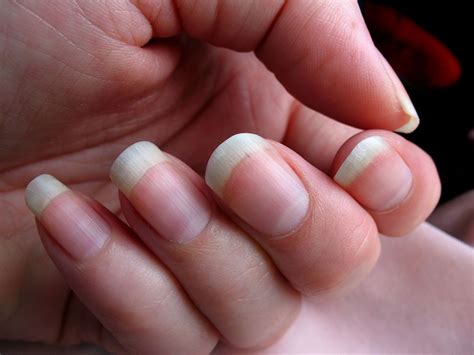 Why Is My Nail Bed Disappearing at Christopher Huff blog