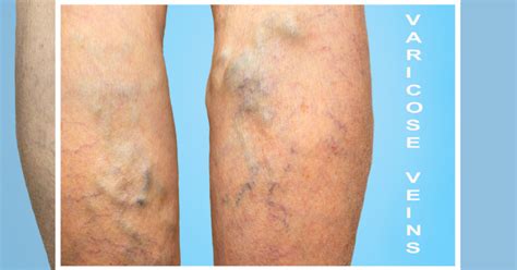 varicose vein treatment denvers top vascular clinic