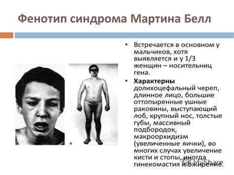 Синдром Мартина Белла - презентация онлайн