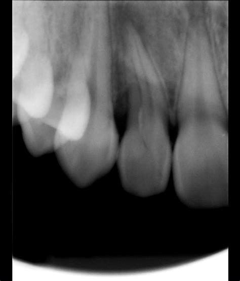 Case Report: Uncommon Maxillary Lateral Incisor with a Type 3 ...