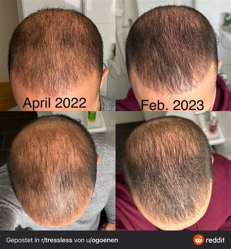 10 months update - Thoughts? (details in comments) : r/tressless