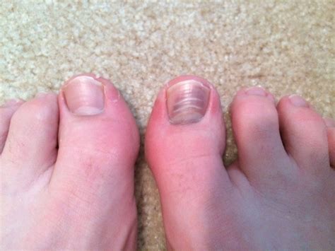 Finally cutting off my dead toenail. : r/popping