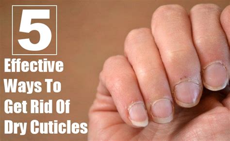 5 Most Effective Ways To Get Rid Of Dry Cuticles | Morpheme Remedies | India