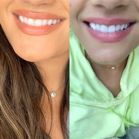 crest 3d white strips review