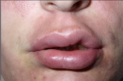 Why Do I Get Hives Around My Lips | Lipstutorial.org