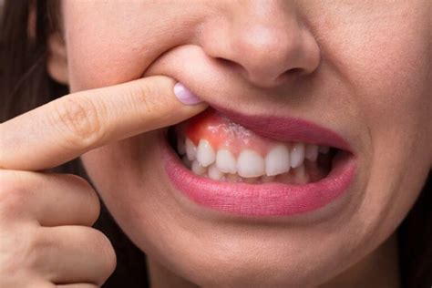 Рак десны: фото, симптомы, признаки, диагностика - Dentist-Club