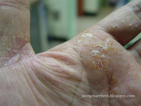 정종영과 메어리벳 : Pompholyx - Skin Diseases Images