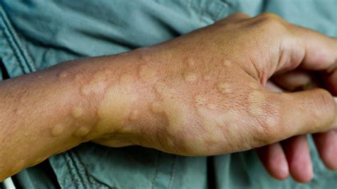 Hives Urticaria Causes Treatment And Symptoms - vrogue.co