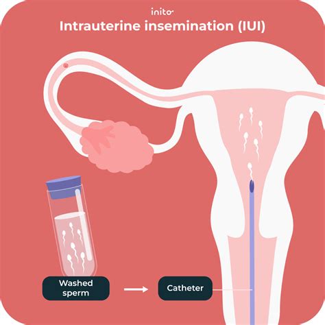 how to iui at home