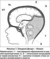 Синдром Денди Уокера (аномалия, мальформация): причины, симптомы, лечение