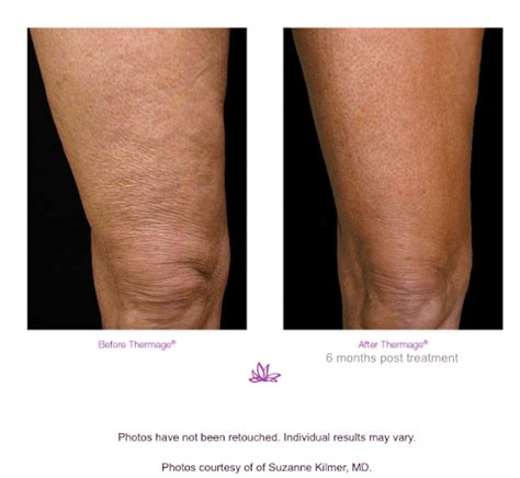 thermage