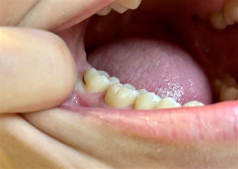 This dark line has been present on my molar for my entire life. What