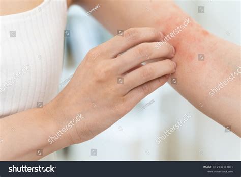 sensitive skin allergic concept woman itching stock photo