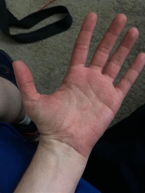 Why does my hand (palm side) do this randomly, without any apparent