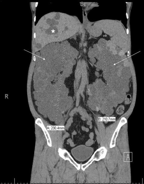 Severe autosomal dominant polycystic kidney disease | BMJ Case Reports
