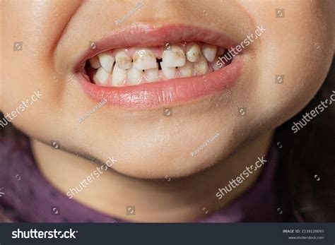 65 Enamel Hypoplasia Stock Photos, Images & Photography | Shutterstock