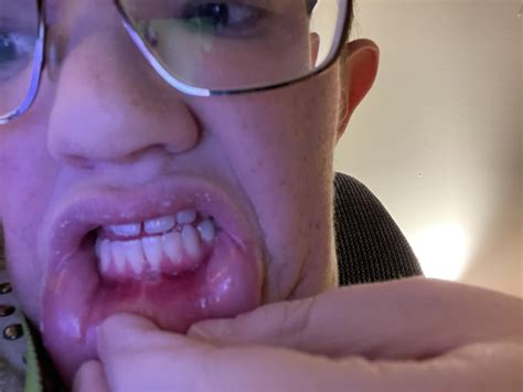 Most Painful Canker I Have Ever Had, I Am Curious Where You Think Is