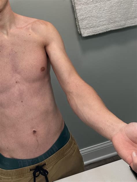 Hiv Rash Cutaneous Manifestations Of HIV Disease Diagnosis