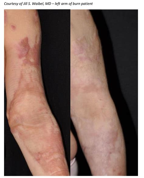 Early Treatment Is Revolutionizing Outcome Of Burn Scars
