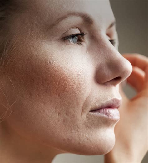ClearSkin Acne Treatment – Cindy Knight Clinic