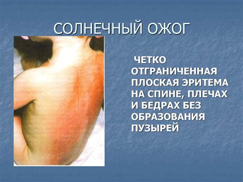 Дифференциальная диагностика инфекционных экзантем у детей ...