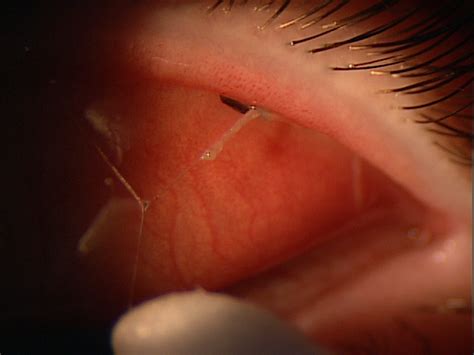 Conjunctival Foreign Body