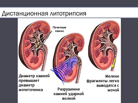 Дистанционная литотрипсия - презентация онлайн