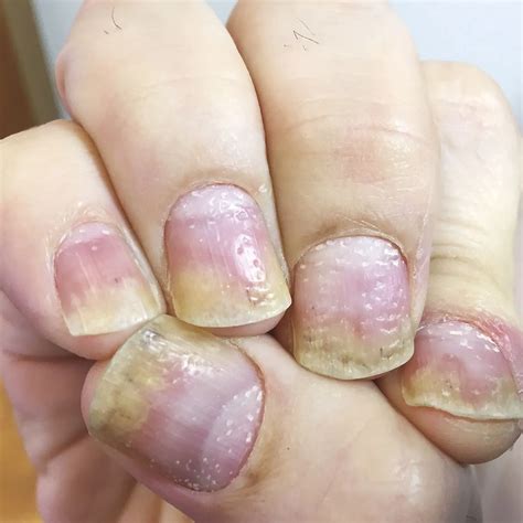 Nail psoriasis - causes, symptoms, treatment - Healthy Food Near Me