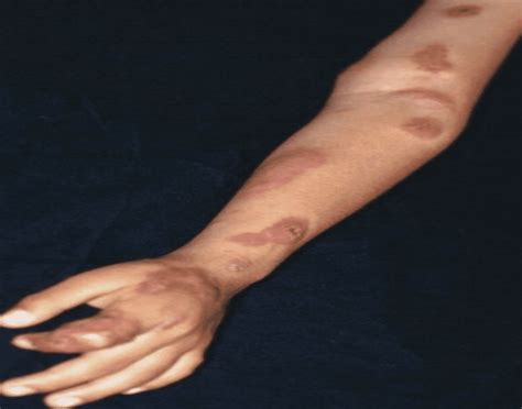 Sporotrichosis NIR Therapy Treatment: A Fungal Breakthrough - LEREDD ...
