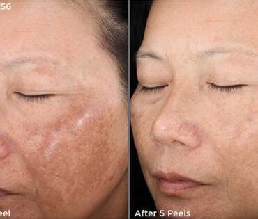 deep chemical peel skinceuticals