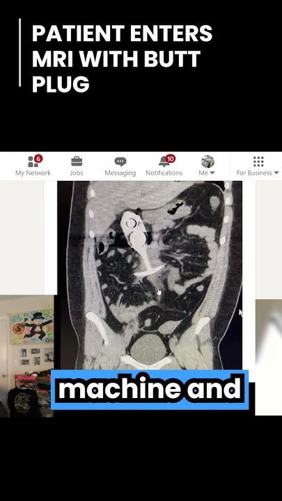 Patient entered MRI with butt plug and this happened - YouTube