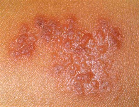 Itchy Skin Rash Infection at Viola Joy blog