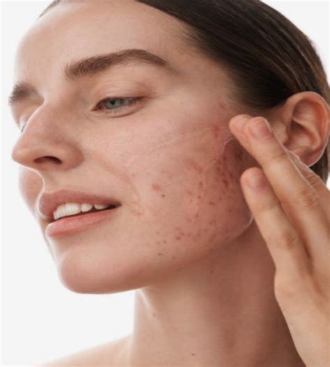 Nodular Acne: Causes and How to Treat It - Bodycraft - Salon, Skin ...