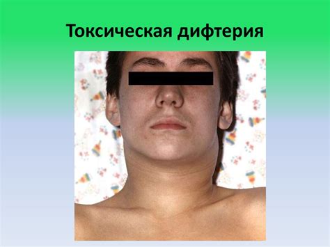 Дифтерия. Возбудитель дифтерии - презентация онлайн