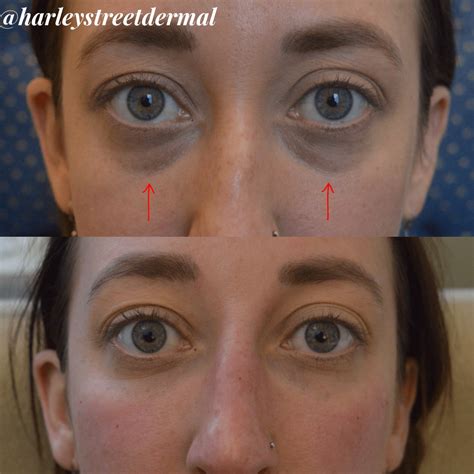 Dark Circles Under Eyes Treatment Cosmetic Surgery at Lavern McDonald blog