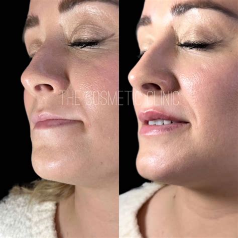 Vitamin Shots In Greenwich, CT | The Cosmetic Clinic