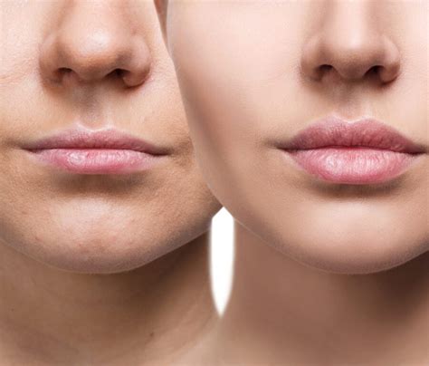 thin lips treatment  minneapolis mn metropolitan skin clinic