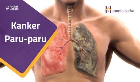 kanker paru paru hanania serka