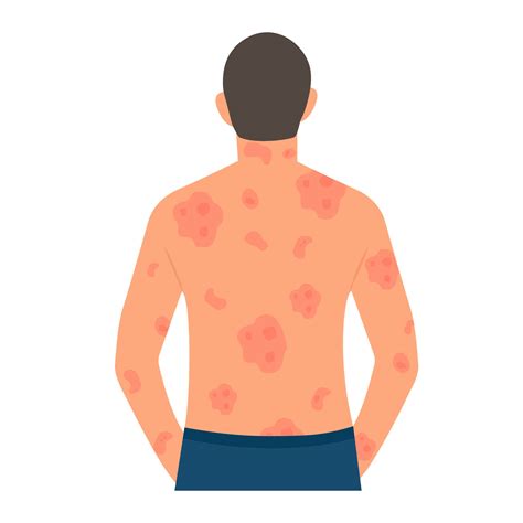 Dermatological skin disease, psoriasis.Allergic itching, skin