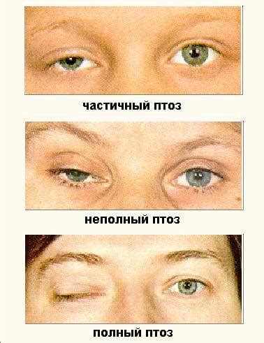Особенности блефарита. общие принципы лечения блефарита. лечение