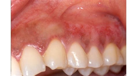 Leucoplasia Pilosa - Patologia Bucal